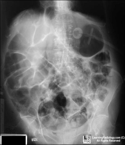 Adynamic ileus